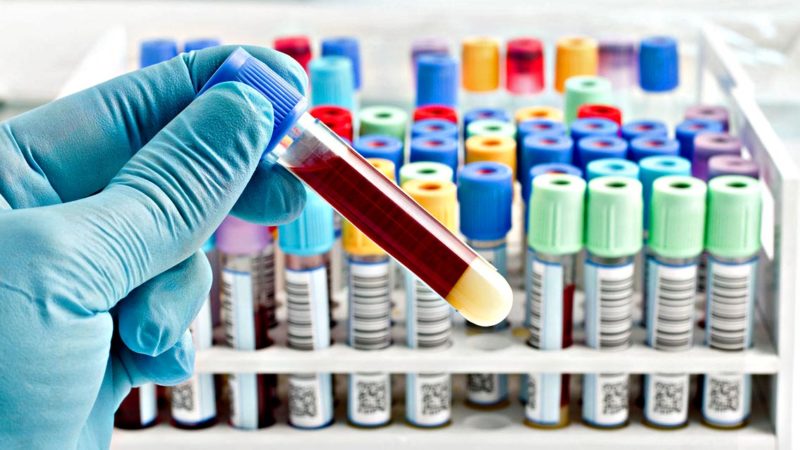 Diagnosticare il coronavirus tramite test sierologici o con i tamponi? La parola al microbiologo