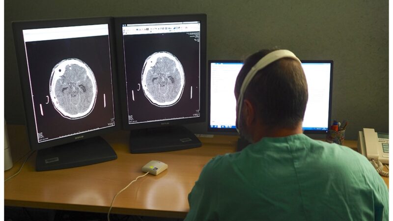 Trattato con successo a Casa Sollievo in Radiologia Interventistica un raro caso di compresenza di aneurisma carotideo e fenestrazione di una arteria intracranica adiacente