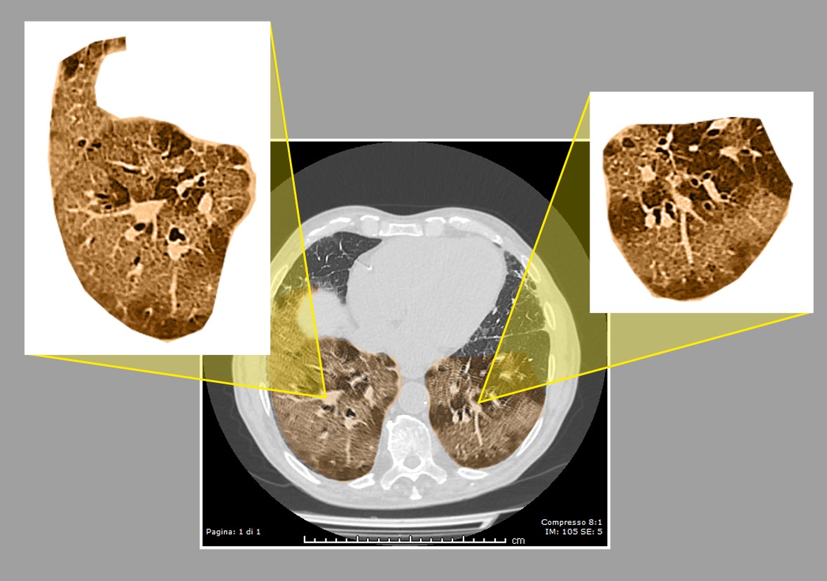IRCCS Casa Sollievo: la diagnosi di Covid-19 attraverso la valutazione clinica e radiologica si dimostra affidabile e mostra alta sensibilità e specificità anche in pazienti con tampone nasofaringeo negativo